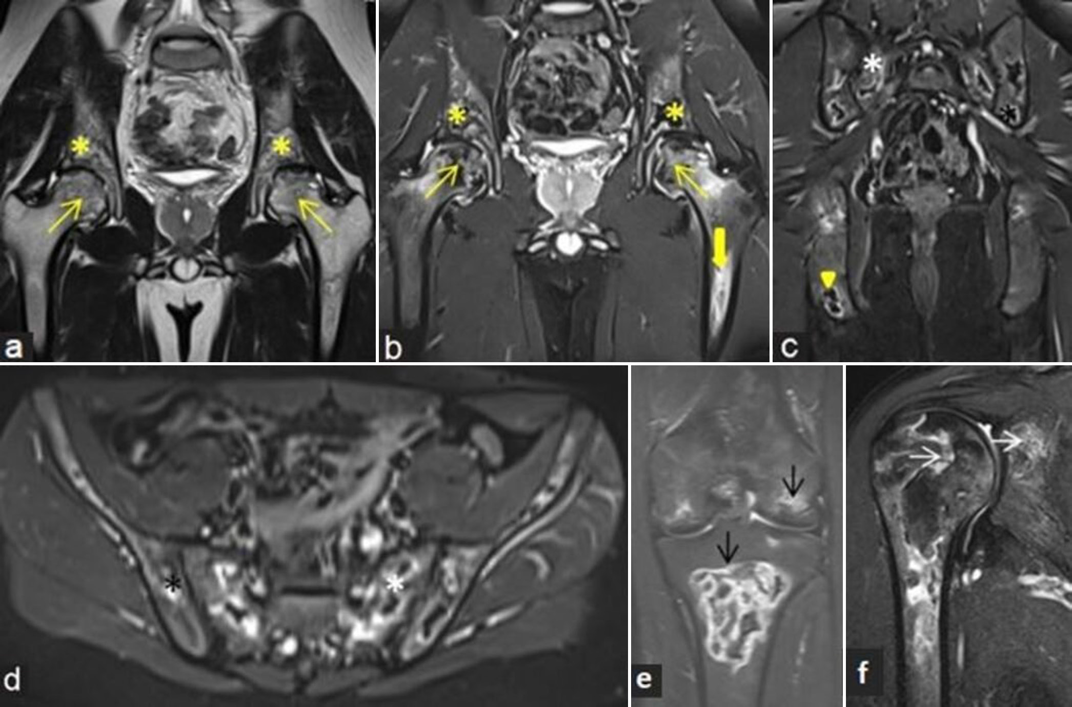 (a-f) A 19-year child with known acute lymphoblastic leukemia presented with bone pains at multiple sites. (a) Coronal T2-weighted image and (b) proton density fat sat magnetic resonance images of bony pelvis with both hips showing osteonecrosis at bilateral femoral heads (yellow arrows) with associated adjacent marrow edema. Similar lesions are also noted along bilateral acetabular margins (yellow asterisks) and left femoral diaphysis (thick yellow arrows). (c) Coronal and (d) axial short-tau inversion recovery (STIR) images of bilateral pelvic bones including sacroiliac joints demonstrate multiple areas of osteonecrosis with peripheral bright signal intensity involving sacrum (white asterisk), iliac (black asterisk), and ischial bones. (e) Coronal STIR images of the right knee and (f) shoulder depict osteonecrosis in distal femur, proximal tibia (black arrows), and proximal humeral and glenoid margin (white arrows).