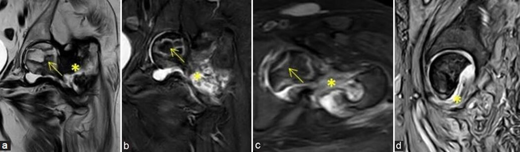 (a-d) Post-traumatic avascular necrosis: A 65-year lady with prior surgery and recent implant removal with non-united intertrochanteric fracture at the left proximal femur and secondary infection at fracture site. (a) Coronal T2-weighted image, (b) coronal short-tau inversion recovery (STIR), (c) axial STIR, magnetic resonance (MR) images and (d) sagittal gradient MR images demonstrate avascular necrosis at the left femoral head (yellow arrows) showing double line sign with old non-united and infected intertrochanteric fracture (yellow asterisks).