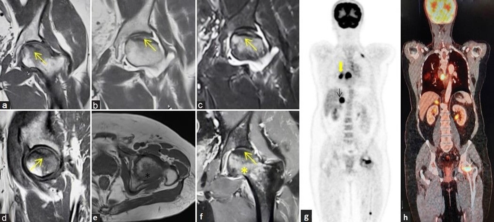 (a-h) avascular necrosis in a case of metastasis: A 67-year man with acute left hip pain. (a) Coronal T1-weighted image (T1WI), (b) T2-weighted image, (c) short-tau inversion recovery magnetic resonance images, and (d) sagittal T1WI images of the left hip demonstrate avascular necrosis at the left femoral head (yellow arrows) with geographic margin and associated left hip joint effusion. (e) Irregularly marginated lesion appearing hypointense in axial T1WI sequence noted at posterolateral part of the left femoral head (black asterisk). (f) Post-contrast T1W coronal image shows non-enhancing area at the site of osteonecrosis (yellow arrow) with increased marrow enhancement within the lesion at posterolateral femoral head (yellow asterisk). (g and h) Whole body positron emission tomography computed tomography imaging was performed and coronal images depicting increased uptake at primary in the lung (thick yellow arrow), metastatic mediastinal nodes, metastatic right adrenal nodule (black arrow), and metastatic foci to the left femoral head (white arrow) and lower femoral diaphysis.