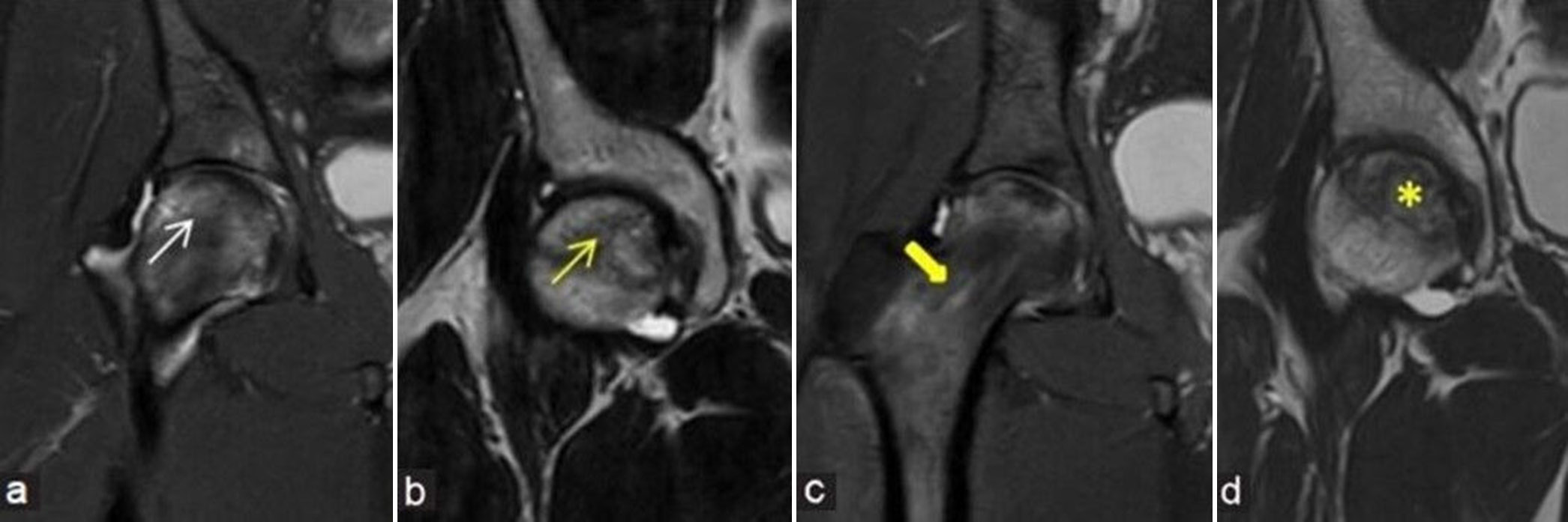 (a-d) Pre- and post-decompression imaging: (a) Coronal fluid sensitive short-tau inversion recovery (STIR) and (b) T2-weighted image (T2WI) magnetic resonance (MR) images of the right hip in a young man demonstrates osteonecrosis of the right femoral head (yellow arrow) with associated marrow edema (white arrow) and no significant collapse of articular surface. He underwent core decompression after a month of diagnosis. Follow-up MR was performed after 6 months. (c) Coronal fluid sensitive STIR and (d) T2WI MR images depict the linear impression of decompression along right femoral head-and-neck regions (thick yellow arrow). There is mildly reduced bone marrow edema and appearance of mild core sclerosis (yellow asterisk) with reduction in brightness of T2 signals when compared to pre-procedural images.