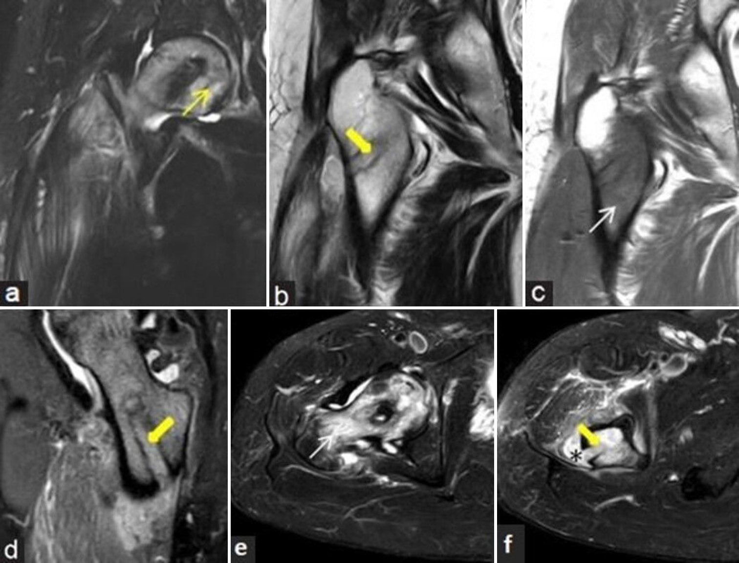 (a-f) Post-decompression infection: 43-year man with prior decompression for the right femoral head osteonecrosis and recent increase in pain with fever. (a) Coronal fluid sensitive short-tau inversion recovery (STIR), (b) T2-weighted image, (c) T1-weighted magnetic resonance (MR) images and (d) T2 gradient echo (GRE) sagittal MR images of the right hip demonstrates osteonecrosis of femoral head (yellow arrow) with linear impression (thick yellow arrow) of decompression along femoral head and neck regions and surrounding bone marrow edema (white arrow in c). Small localized collection noted extending from the decompression tunnel into adjacent soft tissues with surrounding interstitial edema. (e and f) Axial fluid sensitive STIR images delineate the marrow edema (white arrow), linear impression of decompression (thick yellow arrow) and the tracking collection more strikingly (black asterisk). Presence of such extensive marrow edema, tracking soft-tissue collection and soft-tissue edema suggests infection.