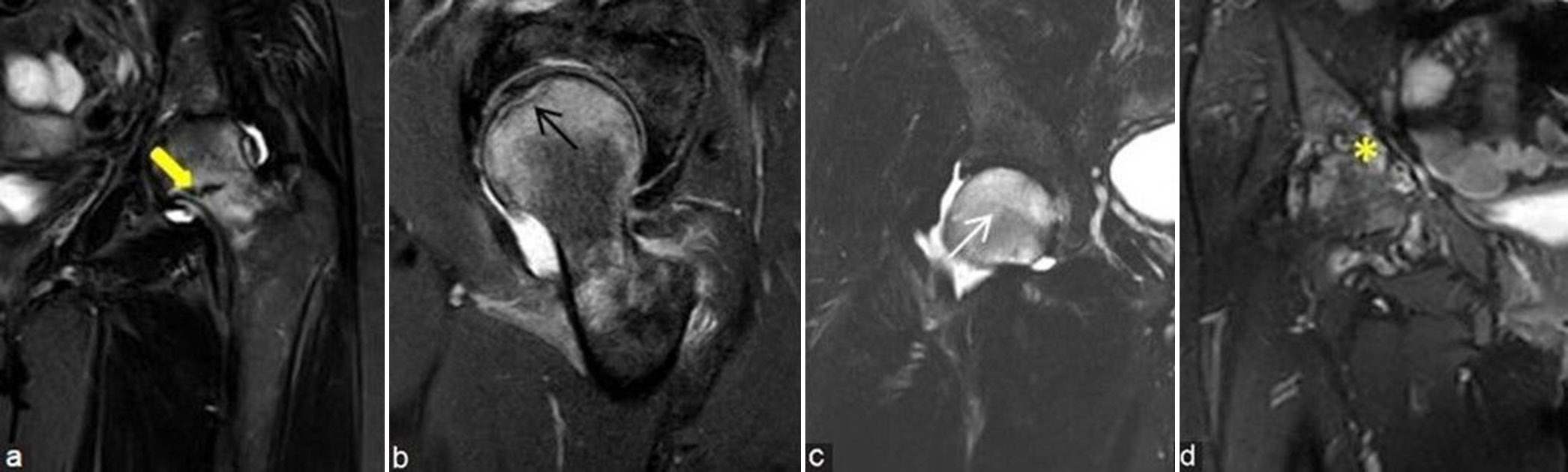 (a-d) Avascular necrosis mimics. (a) Coronal short-tau inversion recovery (STIR) magnetic resonance (MR) image of the left proximal femur in 44-year lady shows marrow edema at head and neck regions with associated incomplete fracture line at medial aspect of neck, consistent with stress fracture (thick yellow arrow). (b) Sagittal STIR image of the left femur in a 52-year man shows marrow edema with low intensity subarticular line, consistent with subchondral insufficiency fracture (black arrow). (c) Coronal STIR MR image of the right hip in a 53-year man shows moderate diffuse bone marrow edema of the right femoral head in a case of bone marrow edema syndrome (white arrow). (d) Coronal STIR MR image of the right hip in a middle aged man shows arthritis changes (yellow asterisk) with moderate subarticular marrow edema with erosions at femoral head and acetabular margins with associated synovitis in a case of inflammatory arthritis.