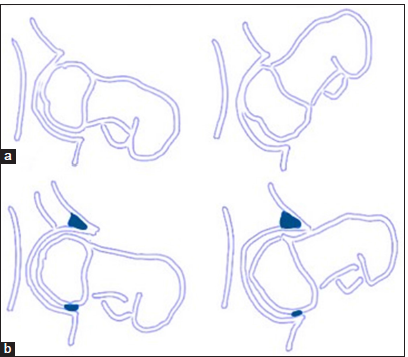 (a) Schematic diagram of a normal hip in flexion showing unrestricted range of motion in flexion. (b) Schematic diagram of a hip with acetabular over-coverage causes premature contact of the femoral head-neck junction and acetabular rim leading to labral and cartilage damage. Posterior subluxations cause counter coup lesions at the posterior-inferior labrum.