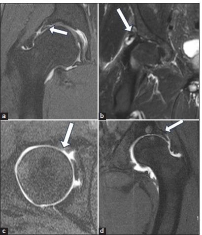 (a) Magnetic resonance (MR) arthrogram coronal T1 fat-saturated image in a 42-year-old female with pincer type of femoroacetabular impingement (FAI) showing a superior labral tear with the contrast extending within the labral substance to >50% of the substance indicating a tear (white arrow). (b) MR coronal proton-density fat-saturated image in a 38-year-old female with pincer type of FAI showing an extensive superior labral tear with labral distortion and associated paralabral cyst formation (white arrow). (c) MR arthrogram axial T1 fat-saturated in a 45-year-old female with pincer type of FAI showing early cartilage damage at the anterosuperior quadrant (white arrow). (d) MR coronal T1 fat-saturated in a 38-year-old female with pincer type of FAI showing lateral weight-bearing acetabular chondral damage (white arrow).