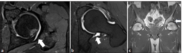 (a) Magnetic resonance (MR) T1 fat-saturated arthrogram axial image showing posterior over-coverage leading to posterior impingement in a 40-year-old male patient. Cartilage damage and bone marrow edema with cortical depression is seen at the posterior aspect (white arrow). (b) MR T1 fat-saturated arthrogram axial image showing posteroinferior labral tear as a part of counter coup lesion in a case of pincer impingement in a 35-year-old male patient (white arrow). (c) MR T1-weighted coronal images showing heterotopic ossification at the labral margins called os acetabuli leading to acetabular over-coverage and contributing to pincer type impingement (white arrow).