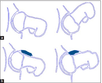 (a) Schematic diagram of a normal hip in flexion showing unrestricted range of motion in flexion. (b) Schematic diagram of Coxa Magna impingement showing an osseous bump at the femoral head and neck junction which causes shearing injury to the acetabular labrum and cartilage on hip flexion.