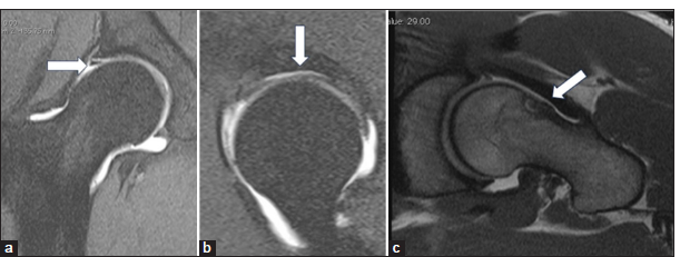 (a) Coronal proton density fat saturated images in a case of Coxa Magna impingement in a 30-year-old male patient with labral-cartilage junction injury (white arrow). (b) Sagittal magnetic resonance arthrogram image showing cartilage delamination injury to the superior labrum between 1 and 11 o’ clock position. (c) T1 axial images showing synovial herniation pit at the femoral head and neck junction (white arrow in a-c).