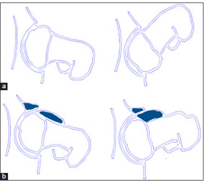 (a) Schematic diagram of a normal hip in flexion showing unrestricted range of motion in flexion. (b) Schematic diagram of mixed impingement. Acetabular over-coverage causes premature contact of the femoral head-neck junction and acetabular rim leading to labral and cartilage damage. The osseous bump at the femoral head-and-neck junction causes shearing injury to the acetabular labrum and cartilage.