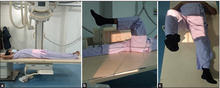 (a) Radiographic positioning for anteroposterior pelvic view is obtained in 15° of internal rotation and heels placed 20–24 cm apart. The central beam is directed mid-way between the anterior superior iliac spine (ASIS) and pubic symphysis, about 5 cm inferior to ASIS and 5 cm superior to pubic symphysis. (b) Radiographic positioning for the cross-table lateral view. The lower extremity is internally rotated to 15° in a supine position and the hip and knee joints on the other side are flexed. A cassette is positioned on the side of the hip at the right angle relative to the incidence angle, thereby projecting toward the groin region at 35–45° of incidence parallel to the longitudinal axis of the femur. (c) Radiographic positioning for the Dunn view. The symptomatic hip joint is flexed to 90° or 45°. Beam is centered to the midpoint between the ASIS and pubic symphysis.