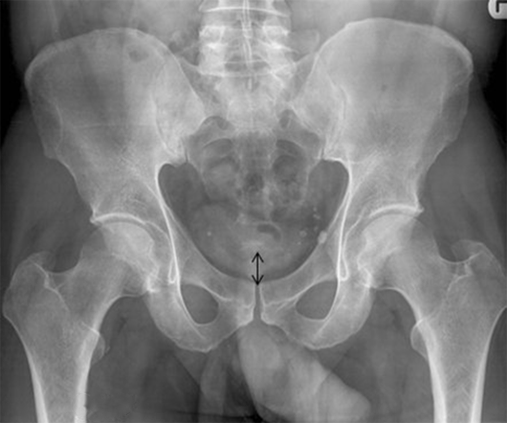 Anteroposterior radiograph: Defining a Neutral pelvic tilt, The sacrococcygeal joint with in 3.2 cms of the symphysis for men or 4.7 cms for women- black arrow. Neutral rotation <5mm.