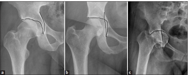 (a) Anteroposterior (AP) radiograph of the right hip joint in a 40-year-old individual showing normal relationship of the floor of the acetabular fossa and the ilioischial line. (b) AP radiograph of the right hip in a 42-year-old male with coxa profunda showing the acetabular fossa medial to the ilioischial line. (c) AP radiograph of the right hip joint in a 48-year-old male patient with protrusio acetabuli showing abnormal medial relationship of the acetabular fossa with the ilioischial line.