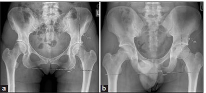 (a) Anteroposterior radiograph in a 40-year-old female patient showing a normal lateral center edge angle which measures the angle between center of femoral head and the lateral edge of the acetabulum. (b) Anteroposterior radiograph in a 35-year-old male patient showing acetabular over-coverage. An angle more than 39° signifies over-coverage. In this patient, the angle measures 44.1°.