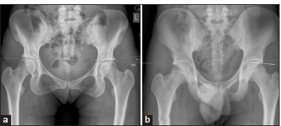 (a) Normal acetabular roof angle in a 25-year-old female patient. The acetabular roof angle is formed between the horizontal plane of the pelvis and a line between the medial edge of acetabular sourcil to the lateral most part of the sourcil. (b) The acetabular angle is zero or even negative in over-coverage as in this case of a 35-year-old male patient with excessive acetabular over-coverage.