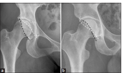 (a) Normal relationship of the anterior (white dotted line) and posterior rim lines (black dotted line) on a right hip anteroposterior radiograph in a 30-year-old male. (b) Cross-over sign or the anterior rim sign, on a anteroposterior radiograph in a 30-year-old male reflects anterior over-coverage or anterior focal acetabular retroversion and is defined as anterior rim line (white dotted line) being projected lateral to the posterior rim line (black dotted line) at the cranial aspect and crossing medial to it distally, in figure of 8 configuration.