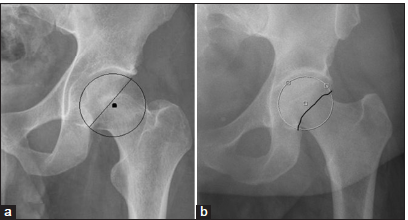 (a) Normal relationship of the posterior rim line on a left hip anteroposterior radiograph in a 30-year-old male. The posterior rim lies at approximately the center of the femoral head or slightly medial (circle). (b) Posterior wall sign is a more prominent posterior wall such that the posterior line lies lateral to the femoral center (circle).