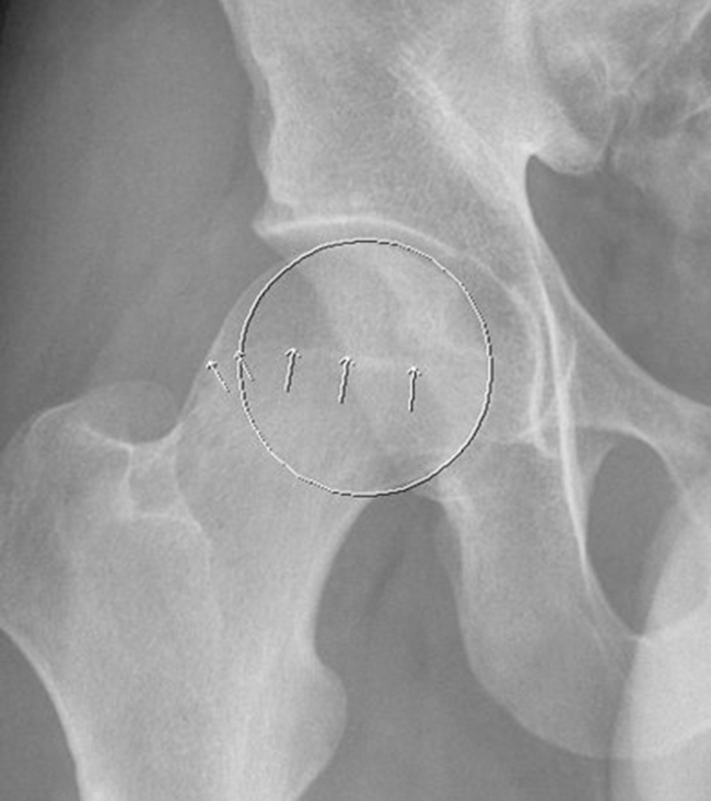 Pistol grip deformity is seen as an osseous bump along the anterosuperior or lateral femoral head-neck junction, which resembles a handle of a pistol due to loss of the normal femoral head neck junction concavity (circle). An anteroposterior radiograph in a 30-year-old male showing the characteristic osseous bump at the femoral head neck junction.