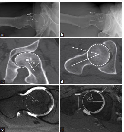 (a) A lateral radiograph showing a normal alpha angle and femoral offset (OS) in a 30-year-old. A circle is drawn around the femoral head (white circle). (b) Abnormally increased alpha angle and reduced femoral offset on a lateral radiograph in a 35-year-old male with Coxa Magna deformity showing a non-spherical femoral head called femoral head asphericity. The alpha angle is measured as an angle between the femoral neck axis and a line connecting the femoral head center with the point of beginning asphericity. An alpha angle >55° is abnormal. Further, there is reduced femoral offset. Circle is drawn around the femoral head (white dotted circle) (c) A 35-year-old male with CAM deformity showing a non-spherical femoral head called femoral head asphericity on a coronal oblique reconstructed non-contrast computed tomography (CT) scan and an abnormal alpha angle (>55°). Circle is drawn around the femoral head (white dotted circle). (d) Axial non-contrast CT scan in a patient with CAM deformity showing femoral head a-sphericity with an abnormal alpha angle (>55°). (e) A 35-year-old male patient showing normal alpha angle on the oblique axial proton density fat saturated (PDFS) images. (f) An abnormal alpha angle (>55°) on an oblique axial PDFS magnetic resonance imaging image in a 36-year-old male patient with associated tear at the anterior labral at the labrocartilagenous junction.