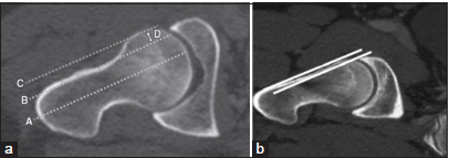 (a) Normal anterior femoral offset in a 30-year-old male patient defined as the difference in radius between the anterior femoral neck and anterior femoral head of the proximal femur and cutoff for the anterior femoral offset is 7.2 ± 0.7 mm for diagnosis of a Coxa Magna impingement on an oblique axial computed tomography (CT) scan. Line A is drawn along the femoral head neck axis. Lined B is drawn parallel to line a through the edge of the femoral neck. Line C is drawn parallel to line A through the edge of the femoral head. Line D is distance between line B & C and reflects the anterior femoral offset. (b) Significantly reduced anterior femoral offset in a 38-year-old male patient with CAM deformity on an oblique axial view CT scan.