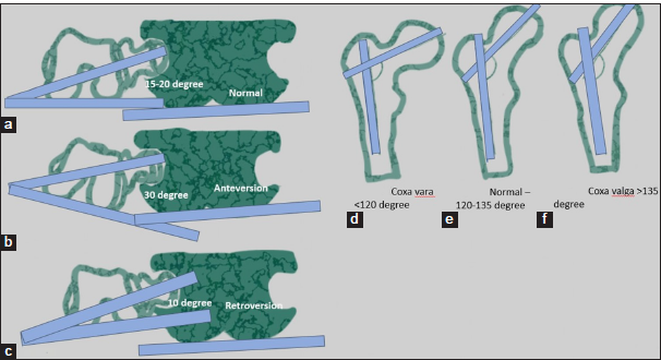 (a) A schematic representation normal angle of anteversion defined as angle between a line connecting the femoral condyles and another line connecting the femoral head and neck. (b) Schematic representation of increased femoral neck shaft angle in increased anteversion. (c) Reduced femoral anteversion angle is referred to as femoral retroversion. (d) Schematic representation of reduced femoral head shaft angle in coxa vara. (e) Schematic representation of normal femoral head shaft angle. (f) Schematic representation of increased femoral head shaft angle in coxa valga. Femoral ante-version and femoral coxa vara are associated with CAM type femoroacetabular impingement.