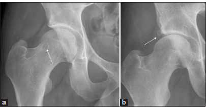 (a) Secondary signs of femoroacetabular impingement (FAI) on radiograph femoral head-and-neck junction cyst in a 35-year-old male patient with CAM impingement (white thin arrow). (b) Secondary signs of FAI on radiograph: An acetabular labral ossicle in a 40-year-old female patient with pincer impingement (white thin arrow).