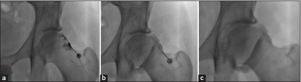 (a-c) Fluoroscopy-guided sequential hip arthrogram images as a preparation for magnetic resonance arthrogram in a 40-year-old male patient showing accurate needle placement at the femoral head-and-neck junction laterally, subsequent distention of the joint capsule with contrast agent and a band like zona orbicularis/annular ligament at the head neck junction.