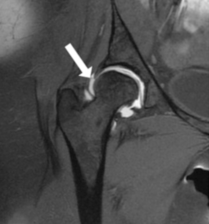 T1 fat-suppressed magnetic resonance arthrogram coronal image in a 30-year-old female patient showing a normal labral anatomy. The labrum is elongated, triangular in shape and is showing a slight hyperintense signal which is normal (white arrow).