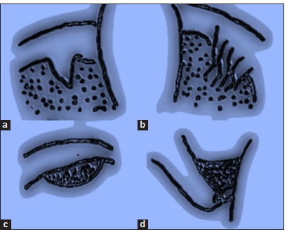 Schematic diagram showing the Lage classification of labral tears: (a) Type 1 damage to the free margin of the labrum results in flap formation. Schematic image of a radial flap tear. (b) Type 2 showing a radial fibrillated tear which occurs due to degenerated labrum resulting in a fibrillated appearance of the labral surface. (c) Type 3 tear as a peripheral longitudinal tear is seen at the junction of acetabulum and labrum. (d) Type 4 tear seen as an unstable labral tear caused by labral subluxation and dysfunction.