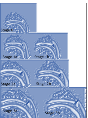 Schematic diagram of Czerny classification of labral tears. STAGE 0-Normal labrum without signal or degeneration appears, triangular and continuous and the perilabral recess is present. STAGE 1a-represents intrasubstance degeneration, the labrum is triangular, and the perilabral recess is present. STAGE 1b-increased intrasubstance labral signal with a thick deformed labrum and the perilabral recess is absent. STAGE 2a-represents a labral tear without labral detachment. STAGE 2b-represents a labral tear without labral detachment with a thick deformed labrum and the perilabral recess is absent. STAGE 3a-represents a labral detachment. STAGE 3b-represents a labral detachment with a thick deformed labrum and the peri-labral recess is absent.