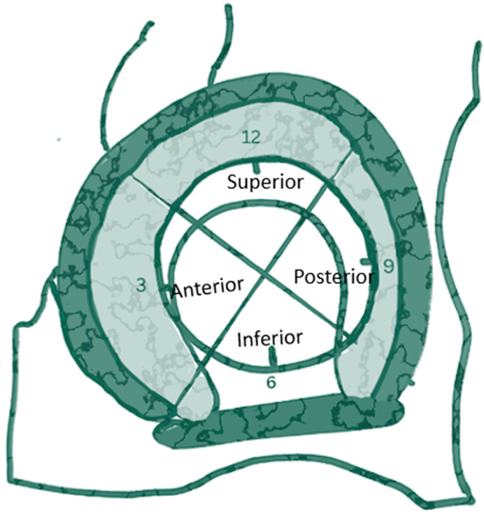 Schematic diagram showing labral tear description according to the quadrants and clock face view according to Blakenbaker’s classification. The acetabular labrum is divided into four quadrants with the superior, anterior and posterior labrum labeled as 12 o’clock, 3 o’clock, and 9 o’clock, respectively. The acetabular labrum is deficient inferiorly and is bridged by the transverse ligament with the midportion labeled as 6 o’clock.