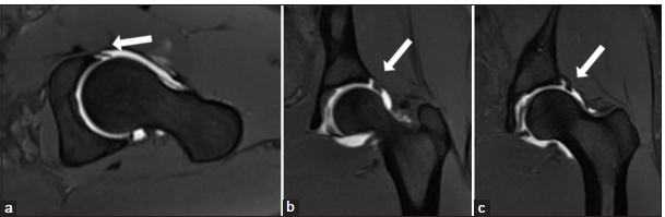 (a-c) T1 fat-suppressed magnetic resonance arthrogram axial and coronal images in a 30-year-old female patient: A characteristic labral tear with a cleft extending from the capsular surface up to more than 50% depth (white arrow).