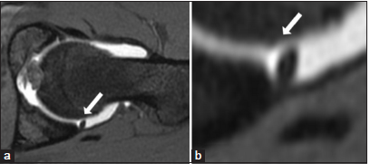 (a and b) T1 fat-suppressed magnetic resonance arthrogram axial image in a 30-year-old female patient showing sub-labral sulcus at the posterior labrum as a smooth edged cleft (white arrow).