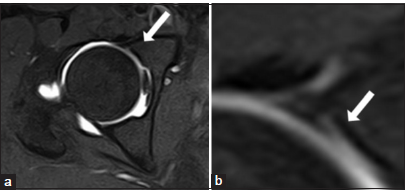 (a and b) T1 fat-suppressed magnetic resonance arthrogram axial image in a 30-year-old female patient showing labrocartilage cleft at the anterior labrum at the junction of the acetabular labrum and the articular cartilage (white arrow).