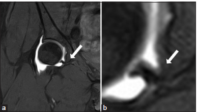 (a and b) T1 fat-suppressed magnetic resonance arthrogram axial image in a 30-year-old female patient showing normal labroligamentum sulcus (white arrow) between the inferior transverse ligament and the acetabular labrum. A periligamentous recess is often seen with this sulcus.