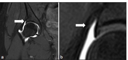 (a and b) T1 fat-suppressed magnetic resonance arthrogram axial image in a 30-year-old female patient showing normal perilabral sulcus between the acetabular labrum and the hip joint capsule (white arrow).