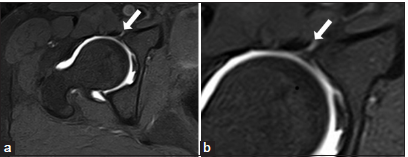 (a and b) T1 fat-suppressed magnetic resonance arthrogram axial image in a 30-year-old female patient showing normal perilabral sulcus between the acetabular labrum and the hip joint capsule (white arrow).