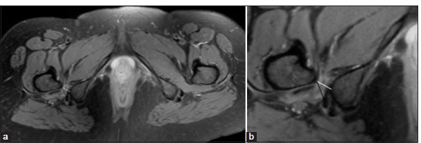 (a and b) Magnetic resonance imaging axial PDFS images in a 34-year-old female patient with ischiofemoral impingement showing right-sided ischiofemoral impingement with reduced ischiofemoral (white line) and quadratus femoris space (black line) measuring <15 mm and 10 mm, respectively. There is quadratus femoris muscle edema and atrophy. The contralateral side shows normal ischiofemoral and quadratus femoris space.