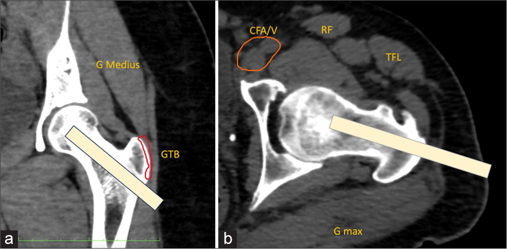 (a) Coronal and (b) axial oblique multi-planar reformatted computed tomography images show a normal left hip. An angled subtrochanteric approach (yellow strip in a and b) should be used for the biopsy of lesions in the femoral neck or head. The greater trochanter bursa (outlined in red in a) and the hip joint capsule should be avoided. GMax: Gluteus maximus muscle, GMedius: Gluteus medius muscle, TFL: Tensor fascia lata muscle, orange outlined is CFA/V: Common femoral artery and vein.