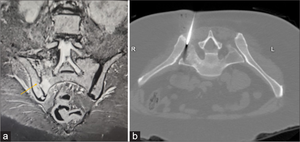 (a) Coronal Short tau inversion recovery (STIR) sequence image depicts acute inflammatory sacroiliitis orange arrow of the right sacroiliac joint. (b) Axial computed tomography image demonstrates the final needle trajectory placed in right sacroilliac joint for aspiration/biopsy.