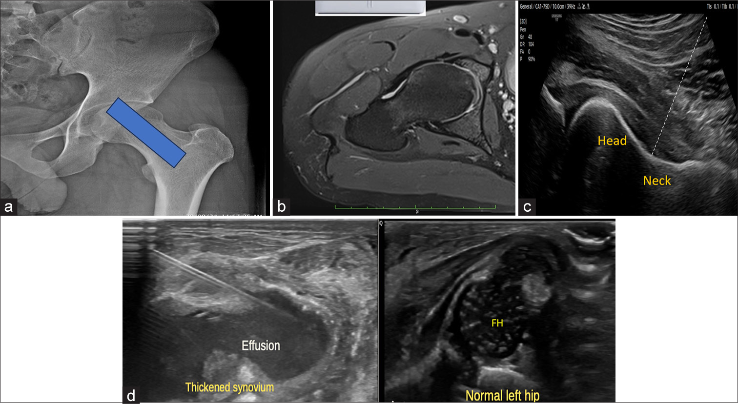 (a) Anteroposterior hip radiograph with overlying blue box shows the site/positioning of the ultrasound probe parallel to the long axis of the femoral neck. (b) Corresponding axial proton density fat saturated magnetic resonance image demonstrates probe site for needle position. (c) Ultrasound at the corresponding level reveals the femoral head junction, the site for needle insertion. The dotted line demonstrates the needle trajectory. (d) Companion case of a 13-day-old neonate presented with swelling in the right hip. Local examination revealed a swollen and tender right hip. Ultrasonography revealed a significant amount of fluid with internal echoes in the right hip joint with synovial thickening. Under aseptic precautions, 12 mL of thick pus was aspirated. Ultrasound images of the affected right hip reveal joint effusion with internal echoes and thickened synovium. The needle track is visualized. Ultrasound image of normal left hip demonstrates normal femoral head capital epiphyses. FH: Femoral head.