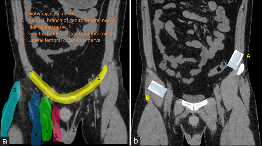 (a) Dermatomal distribution of pelvis. (b) Position of the ultrasound probes for A: Ilioinguinal and B: genitofemoral nerve blocks.