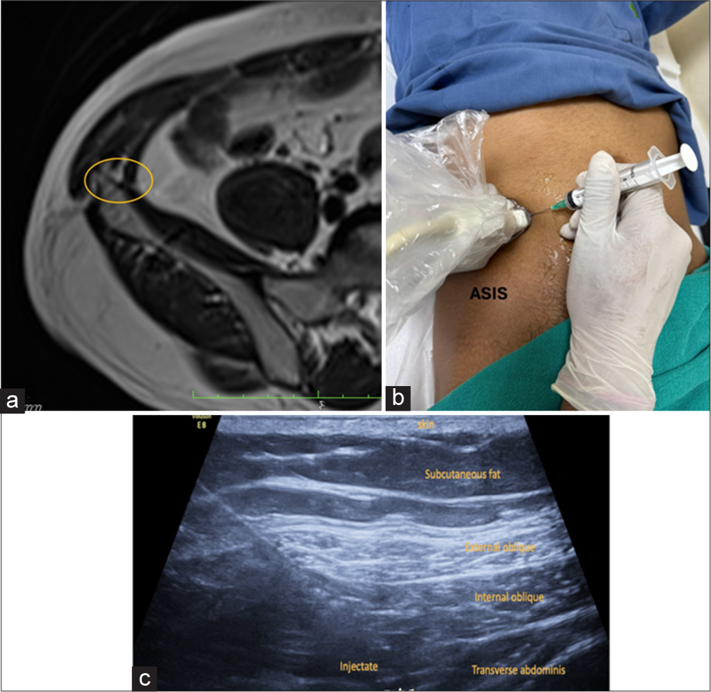 (a) Axial T1-weighted magnetic resonance image depicts the normal site marked by yellow circle of the ilioinguinal nerve within the transverse abdominis plane in the anterolateral abdominal wall. (b) The patient is in the supine position for the block with probe positioned superomedial to the ASIS. ASIS: Anterior superior iliac spine (c) ultrasound image shows final injectate in the transverse abdominis plane.