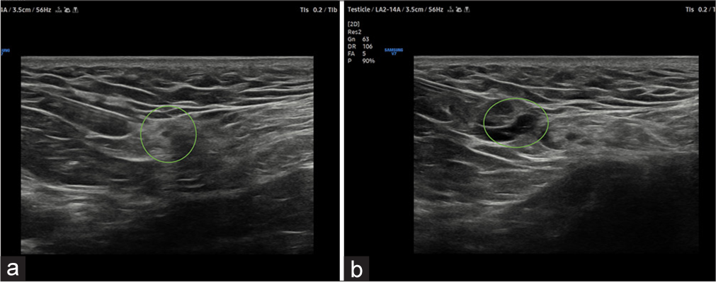 (a) USG image shows the needle trajectory from the lateral to the medial approach for genitofemoral nerve block. Green circle depicting the spermatic cord structures. (b) There is the spread of injectate green circle surrounding the genitofemoral nerve.