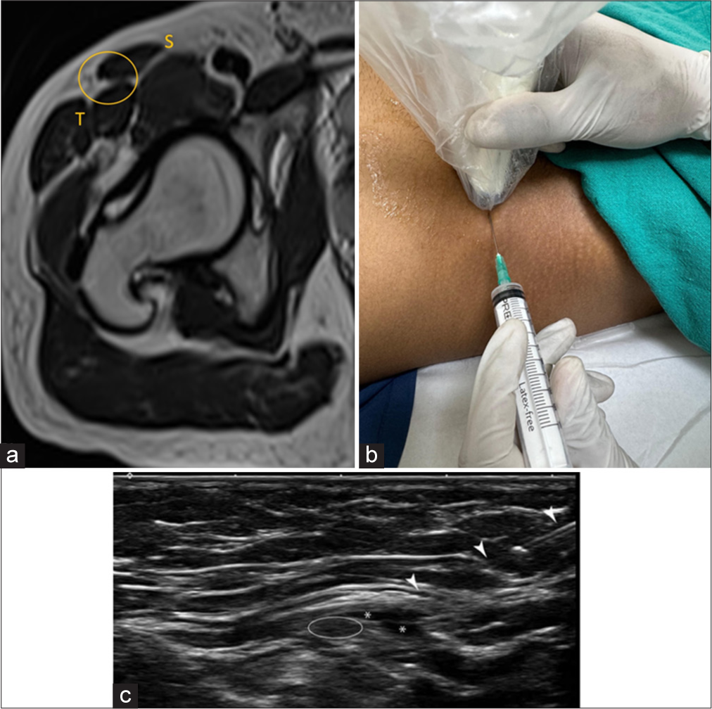 (a) Axial T2-weighted magnetic resonance image image at the level of right hip depicts the normal plane of the lateral femoral cutaneous nerve and site of injection marked by yellow circle. S: Sartorius and T: tensor fascia lata. (b) The patient is in a supine position with transducer placed at anterosuperior iliac spine. The needle is inserted from the lateral to medial in-plane approach. (c) USG image at the corresponding level demonstrates needle track (arrowhead) and white circle demonstrating lateral femoral cutaneous nerve. Asterisk demonstrates the spread of injectate.