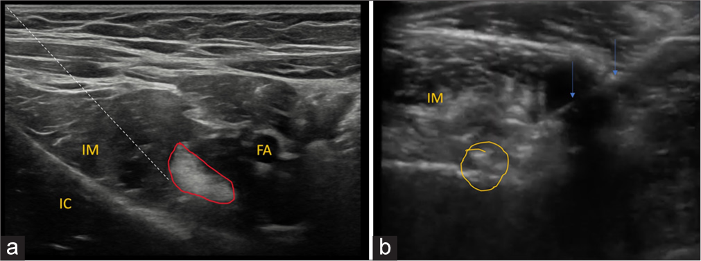 (a) Ultrasound image at the level of iliopsoas myotendinous unit. The dotted line demonstrates the needle track. Iliopsoas myotendinous unit demonstrated in red outline. FA: Femoral artery, IC: Iliac crest, IM: iliacus muscle. (b) Axial ultrasound image demonstrates needle track-arrow within the iliopsoas bursa with the spread of injectate with few air loculi- circled in yellow deep to iliacus muscle.