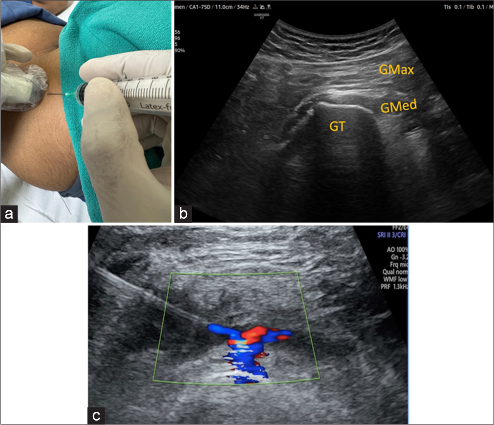 (a) The patient is in a lateral decubitus position with an affected hip up. (b) USG image at the corresponding level demonstrates gluteus medius tendon inserting over GT. GT: Greater trochanter, Gmax: Gluteus maximus and Gmed: Gluteus Medius. (c) USG image with color Doppler images depicts the final spread of injectate. Green box demonstrates color doppler window..