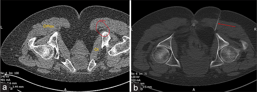 Post total hip arthroplasty status. Patient is in prone position. (a) Axial computed tomography (CT) image at the level of pelvis demonstrates planning with a grid attached to the skin surface. (b) Axial CT image shows the final spread of injectate for pudendal nerve block.