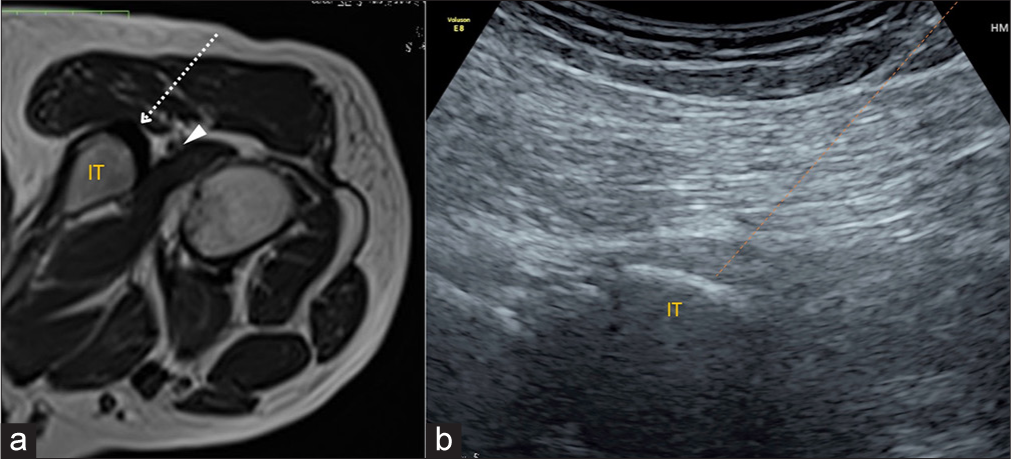 (a) Platelet-rich plasma injection into the hamstring tendon origin. (a) Axial T1-weighted magnetic resonance image of the hip with the patient in the prone position. Needle trajectory-dotted arrow from the lateral to medial aspect into the hamstring tendon origin. The IT serves as an osseous backstop for the needle. The sciatic nerve (arrowhead) travels in close proximity to the hamstring tendon origin and must be visualized and avoided during the injection procedure. (b) Transverse ultrasound image shows the needle tract (orange dotted line). IT: Ischial tuberosity.