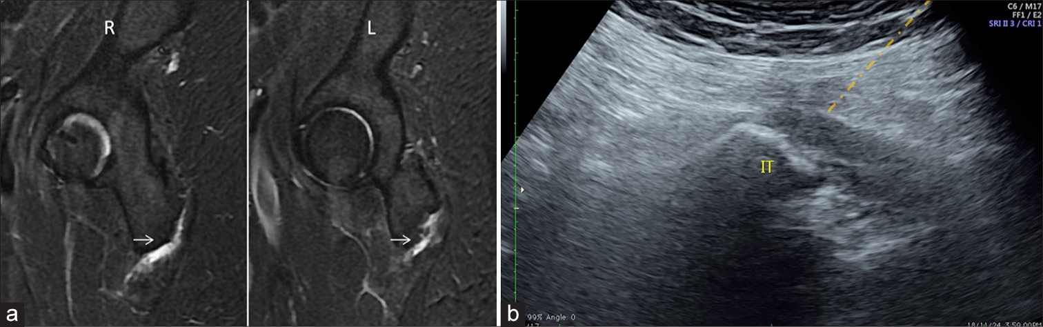 (a) Sagittal magnetic resonance image of right-R and Left-L hip reveals fluid within the bilateral ischiogluteal bursa suggestive of bursitis. (b) Ultrasound image at the corresponding level shows the orange needle tract for injection. IT: ischial tuberosity. Hamstring origin is outlined in red.