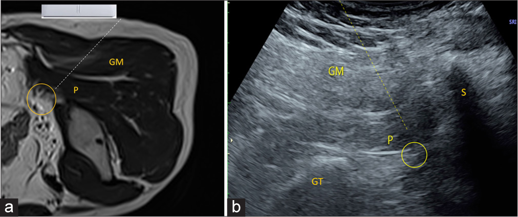 (a) Axial T2-weighted magnetic resonance image sequence shows probe positioning in prone positioning for piriformis injection. P: Piriformis, GM: Gluteus maximus, Yellow circle demonstrates sciatic nerve. Dotted line demonstrates needle track. (b) Ultrasound image demonstrates needle tract for sciatic nerve hydrodissection. The yellow dotted line demonstrates the needle track. P: Piriformis, GM: Gluteus Maximus, Yellow circle demonstrates sciatic nerve. GT: Greater Trochanter, S: Sacrum.