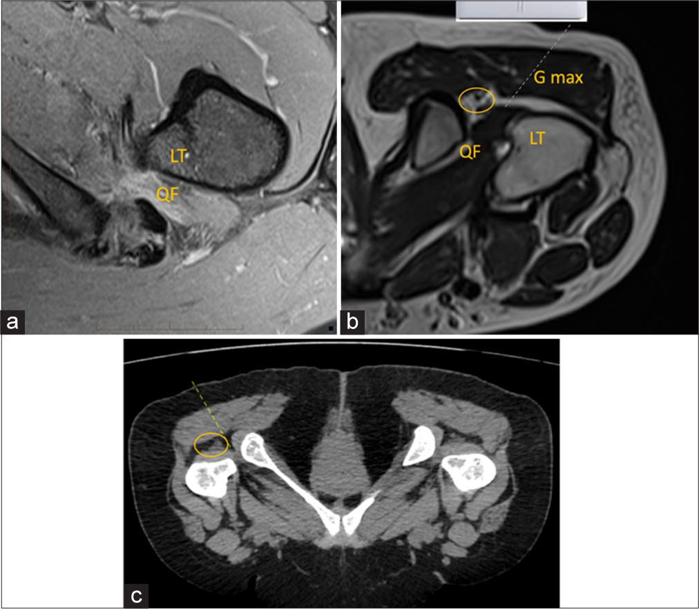 (a) Axial proton density fat saturated magnetic resonance image (MRI) image depicts edema in the quadratus femoris muscle and narrowing at the ischiofemoral space representing impingement. (b) Axial T2-weighted MRI sequence shows probe positioning in prone position for ischiofemoral space injection. QF: Quadratus femoris, Gmax: Gluteus maximus, LT: Lesser trochanter. Dotted line is the-needle trajectory. Yellow circle demonstrates sciatic nerve. (c) Axial computed tomography reformatted images depicting the needle track. Yellow circle demonstrates sciatic nerve.